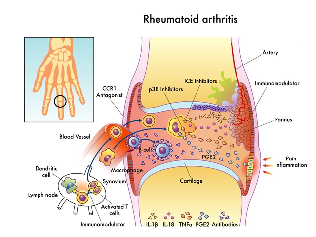 The Impact of Azilsartan on Blood Pressure in Patients with Rheumatoid Arthritis